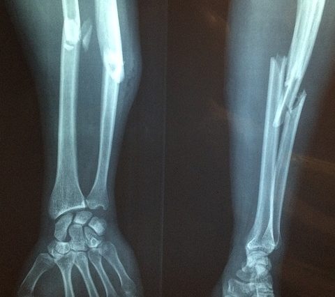 Лікування переломів вилицевого комплексу, що призвели до зміни об&rsquo;єму орбіти (автореферат)